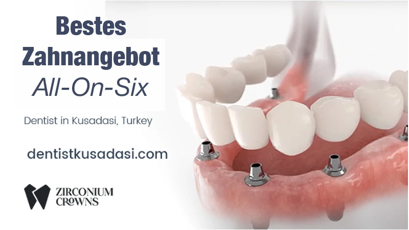 Bestes Zahnangebot – All-On-Six